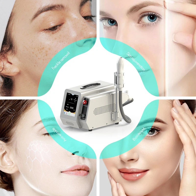 машина для удаления татуировок